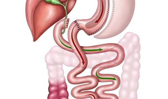Duodenal Switch Surgery icon