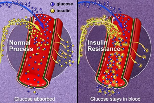 Gastric Sleeve Type 2 Diabetes Treatment: Evidence Grows
